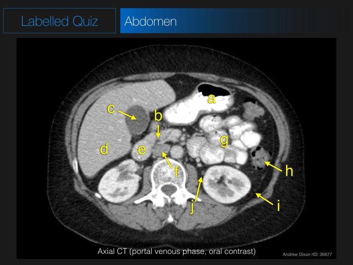 Muscles of the abdomen quiz