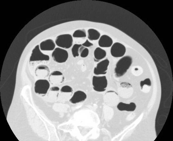 Muscles of the abdomen quiz